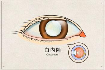 合肥爱尔眼科告诉你：白内障做完手术后会复发吗？  